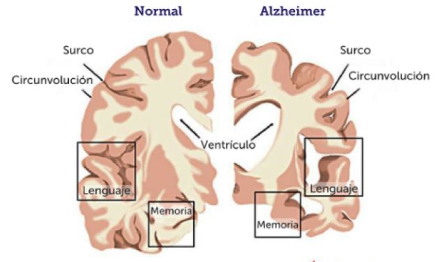 cerebro con alzheimer