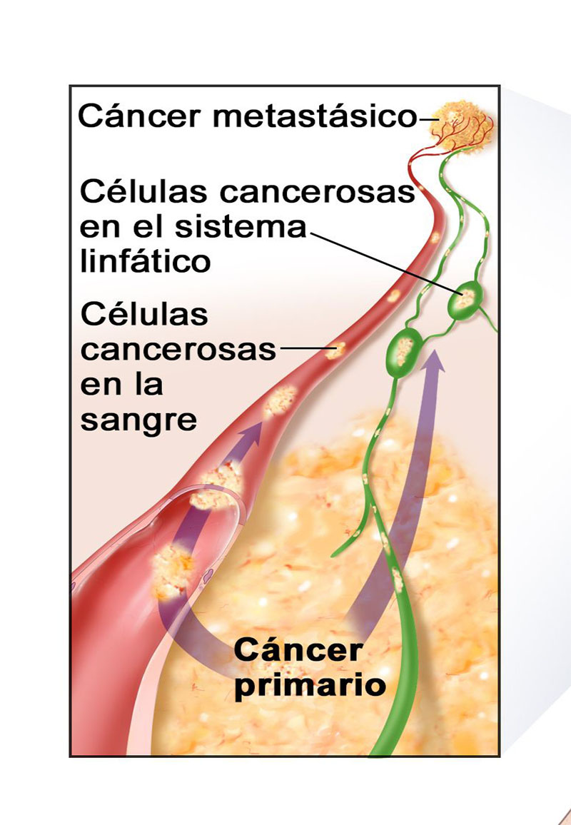 cuerpo con cancer